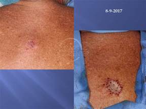 melanoma in situ removal